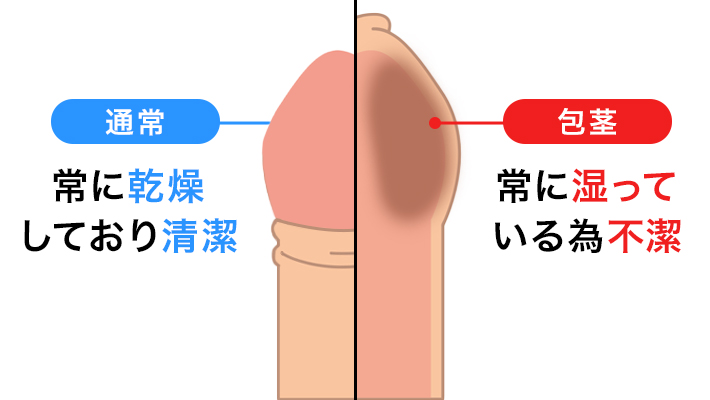 包茎手術 | 性感帯と自然な仕上がりを重要視した包茎手術は沖縄のひろ耳鼻科・皮膚科・形成外科