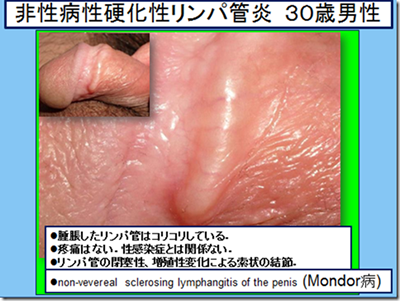 骨盤臓器脱 (子宮脱/膣脱・性器脱/膀胱瘤/尿道瘤) とは？ | 【公式】フェミクッション