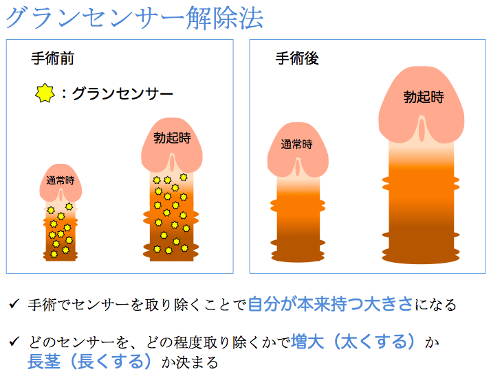 泌尿器専門医が解説】異物を入れずにカリ高ペニスを作る唯一の方法