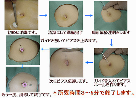 舌に膿のようなものができました | ピアス穴あけ(ボディピアス)の治療への不安（痛み・失敗・副作用）