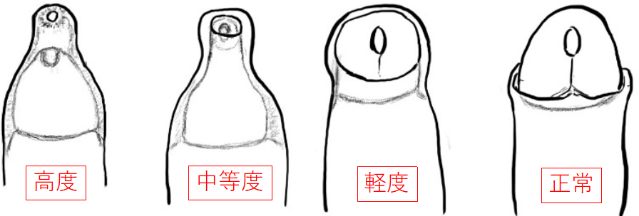 仮性包茎を自力で直せる？リスクと正しい治療法をわかりやすく解説 - まちかど薬局情報館