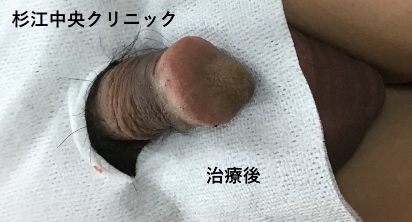 G責めカリキャップ ダブル ペニスサック