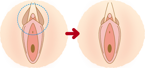 女性器整形婦人科形成 | ガーデンクリニック 美容外科・美容整形
