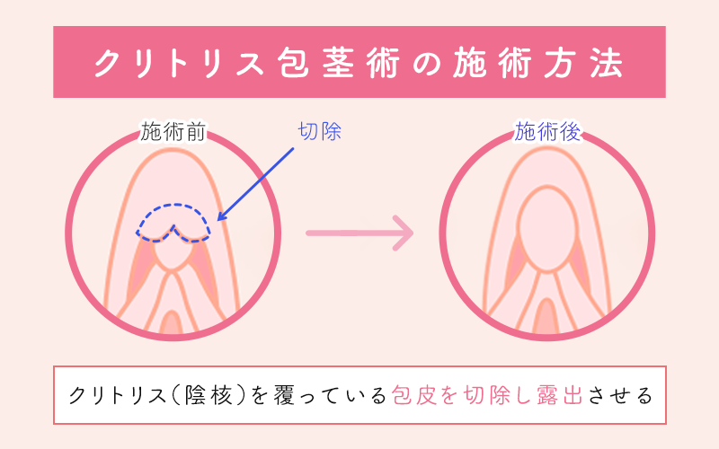 【自腹でデータ入手！】クリトリスの全景こんな感じ！カラダを知るお風呂場