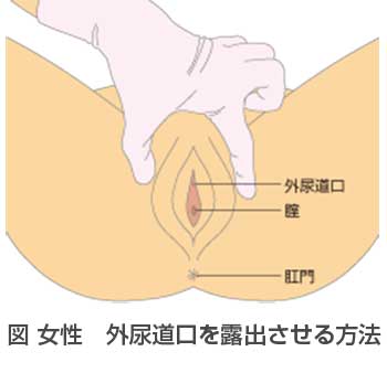 尿道カテーテルQ&A「尿道カテーテル挿入・留置時の尿道損傷、どう防ぐ？」│看護師ライフをもっとステキに ナースプラス