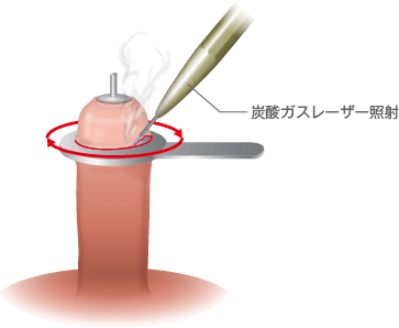 嵌頓包茎（かんとんほうけい）の痛みについて | 医療現場からの報告| 包茎手術のことなら皐月クリニック