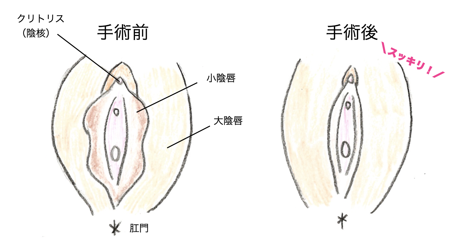 恥垢が溜まりやすいです。効果的な治療はありますか？ | 銀座マイアミ美容外科