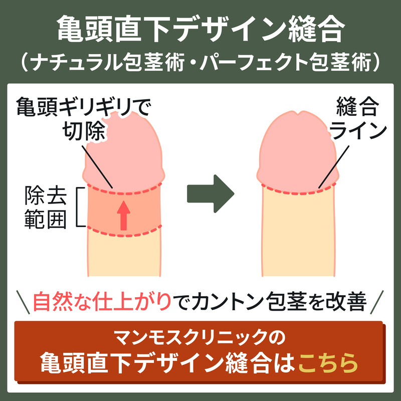 カントン包茎 | エーツークリニック