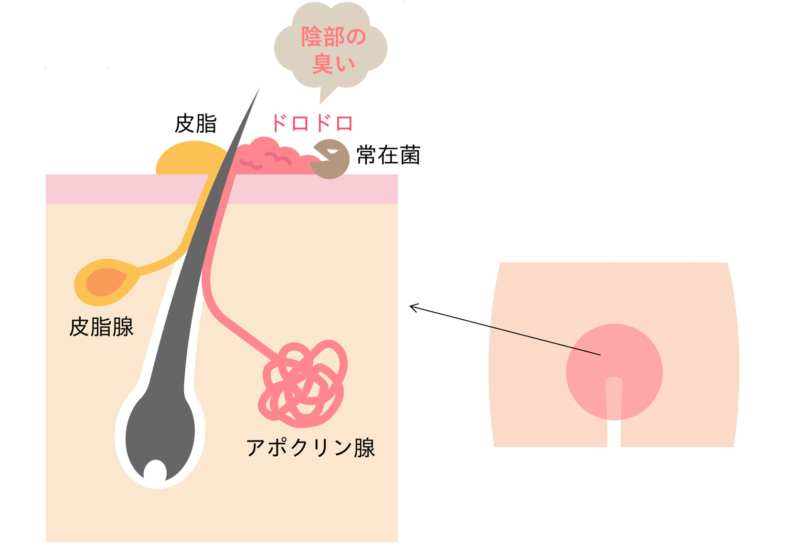 大阪のブラジリアンワックス・ワックス脱毛サロン ラヴァコケット