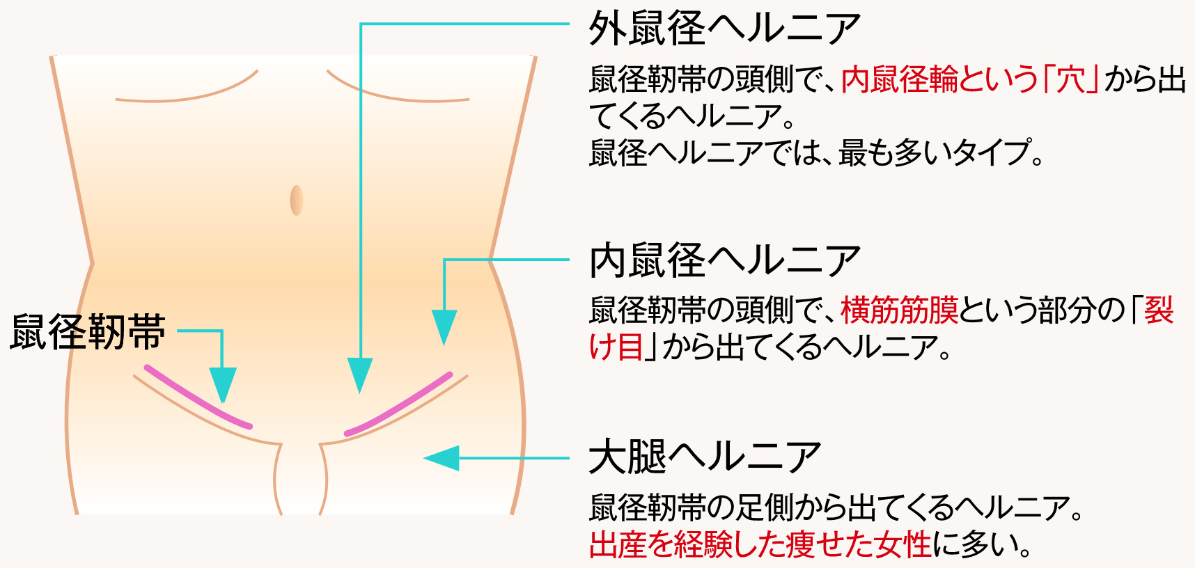 鼠径ヘルニア | 聖マリアンナ医科大学 横浜市西部病院