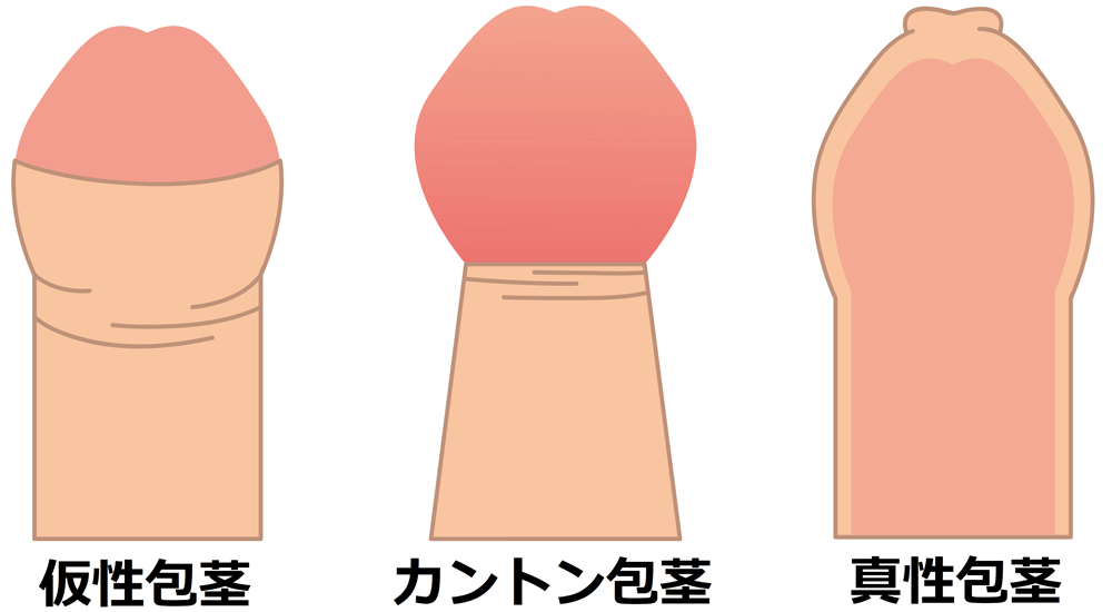 包茎のコンドームの付け方！包茎でもセックスを楽しむ方法 –メンズクリニック研究会-包茎