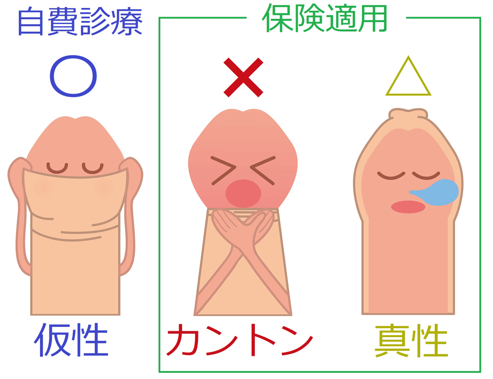 包茎の種類と特徴が知りたい。デメリットはありますか？【専門医が回答！男性の体Q&A③】 | yoi（ヨイ） -