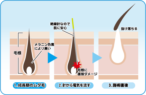 脱毛後の毛嚢炎｜治らないときは脱毛できない？治し方と予防 | 内科総合クリニック人形町