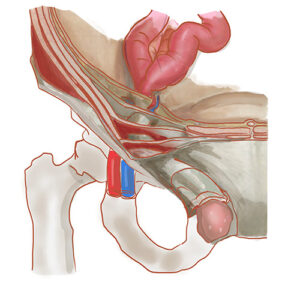 鼠径ヘルニアの手術に必要な解剖 - MIDSクリニック┃大阪梅田駅直結,鼠径ヘルニア(脱腸),虫垂炎(盲腸),日帰り手術専門クリニック