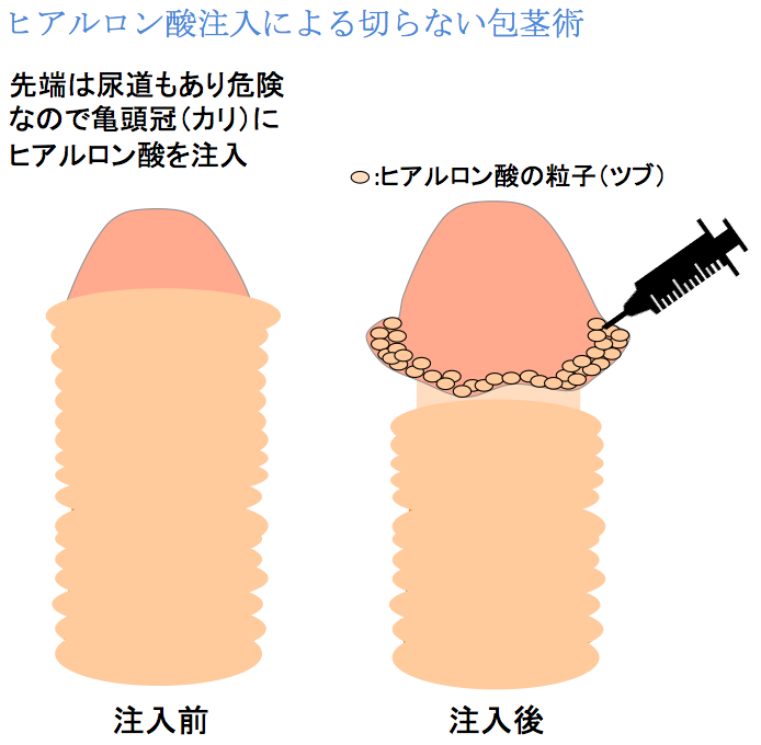 包茎手術 | 種類別の治療法・費用・注意点