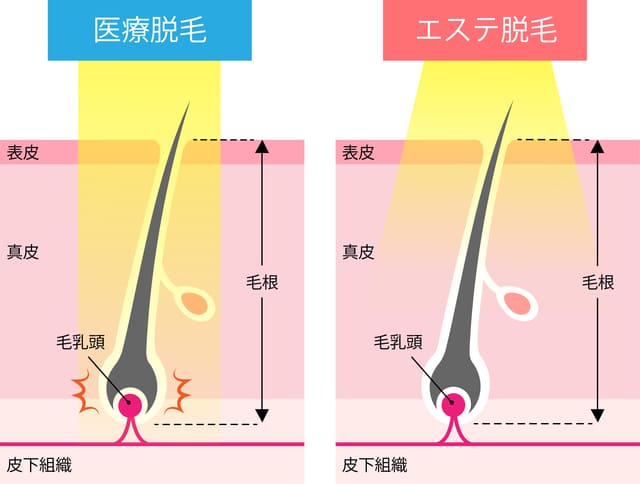 アルパカひげ抜き同好会: 血がついたヒゲ