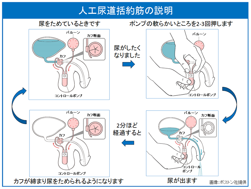 PC筋トレーニング | アネロスジャパン |