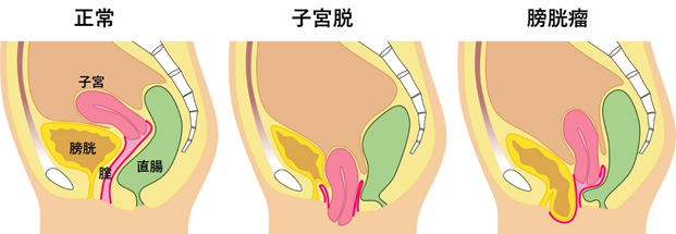 不正性器出血（生理以外の出血）｜山口レディスクリニック 神戸三宮の婦人科クリニック