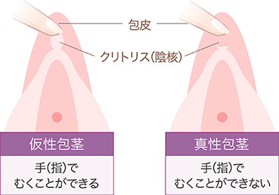 クリトリス包茎で叶える快適なインティメイトケア | ガーデンクリニック