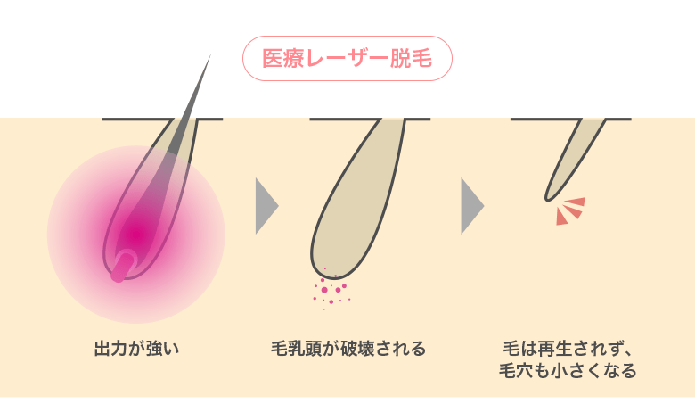 福岡/久留米 ブラジリアンワックス メンズブラジリアン 保湿と埋没毛について