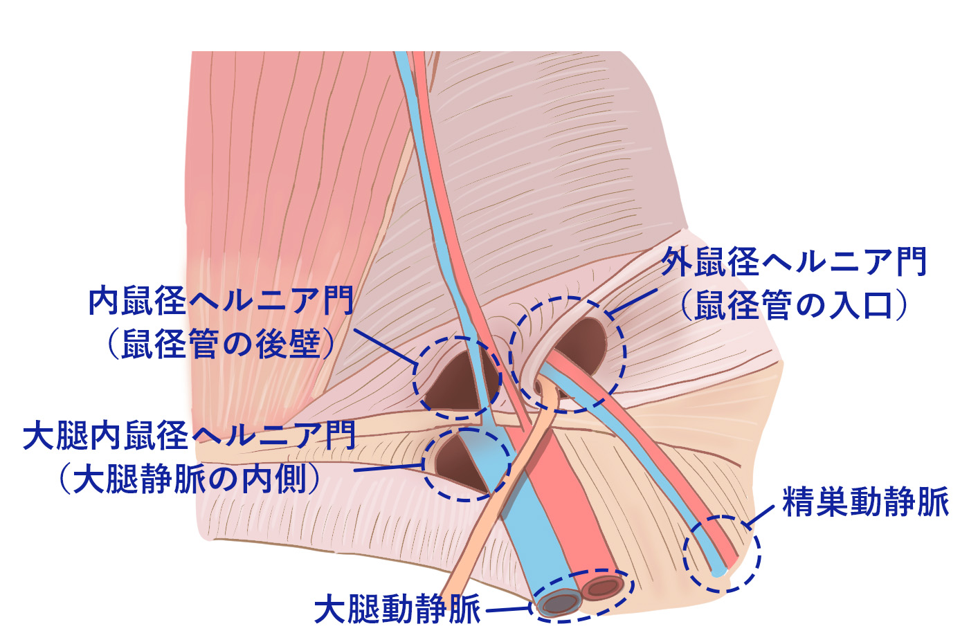 鼠径部の構造的な弱点 男性編｜鼠径ヘルニアの日帰り手術｜横浜青葉そけいヘルニア・外科クリニック