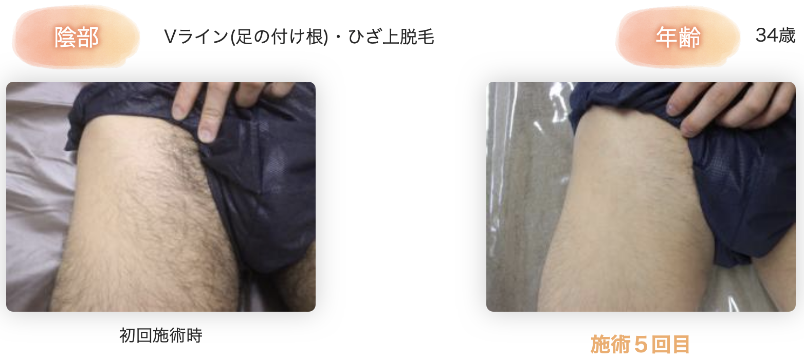 男性がパイパンにするメリットと注意点とは？処理方法まで丁寧に解説をしていきます│メンズジェニー