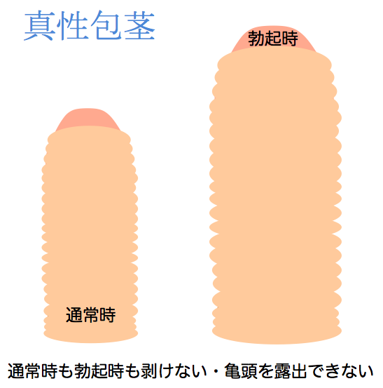 仮性包茎について – メンズ形成外科 | 青山セレス&船橋中央クリニック