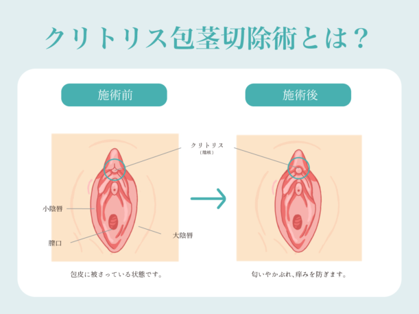 小陰唇のお悩み|福岡ブリスクリニック