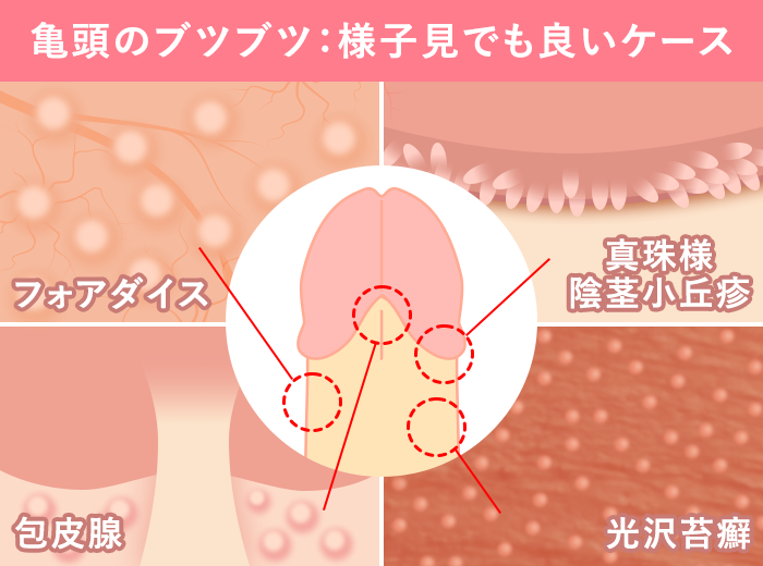 風俗を利用する性病客の見分け方！疑わしいお客さんの対処法を学ぼう | 風俗求人『Qプリ』