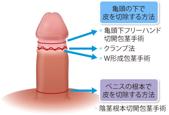 ペニスのブツブツ、５分でキレイに！ – メンズ形成外科