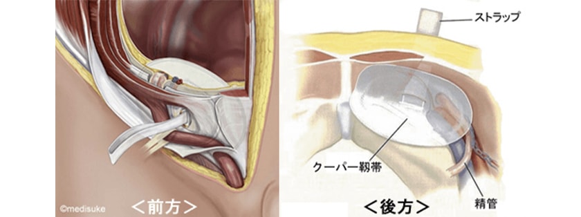 傷跡が目立たず再発を抑えた鼠径ヘルニア短期滞在手術｜茨城県つくば市で鼠径ヘルニアの手術なら筑波胃腸病院