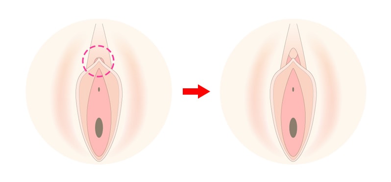 男性向け】クリトリスの皮の剥き方│包茎の見分け方・注意点もご紹介！｜駅ちか！風俗雑記帳