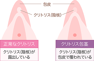 クリトリス包茎 ： 婦人科・女性器：美容外科 高須クリニック