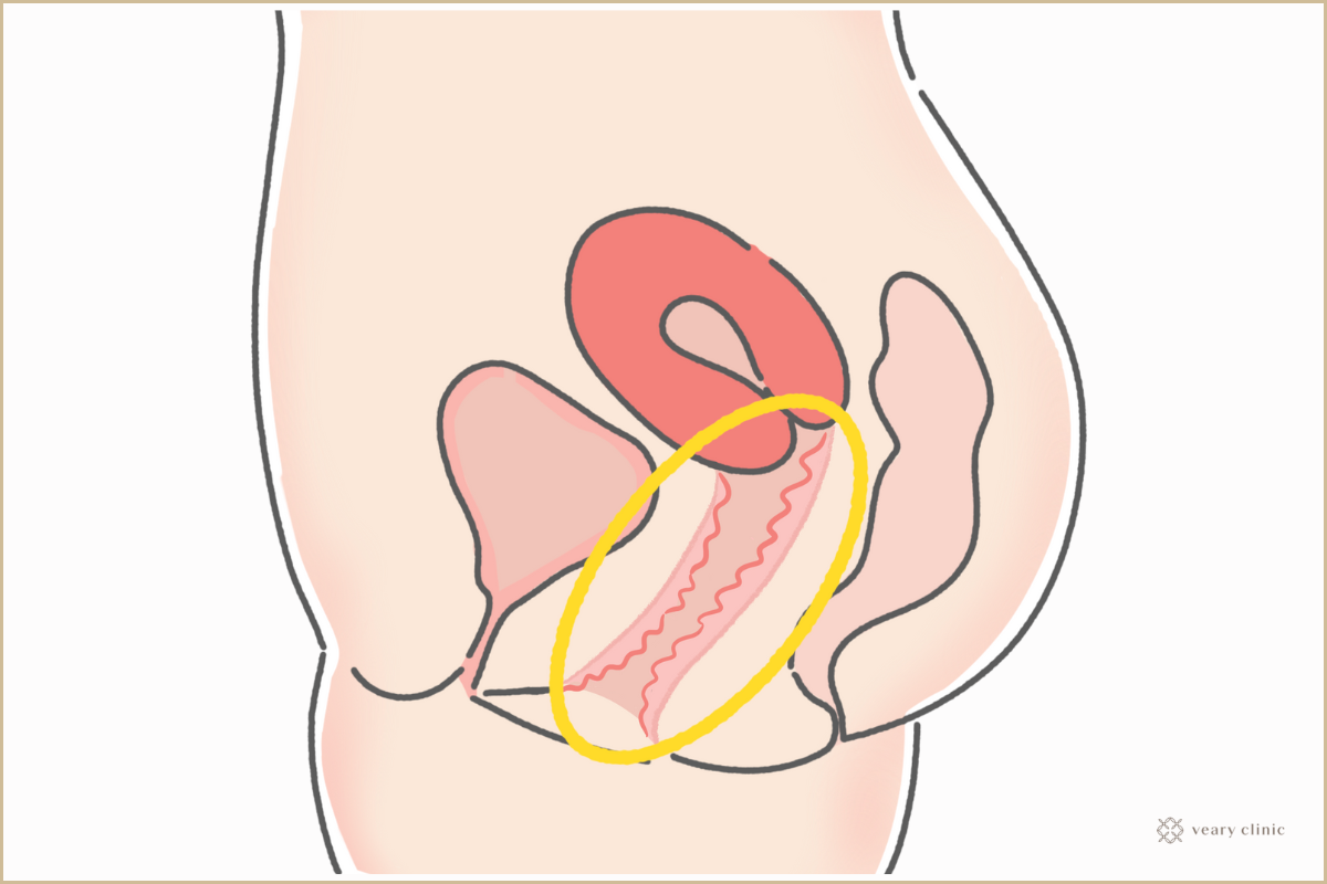 骨盤臓器脱の主な症状：当てはまったら要注意！ | 【公式】フェミクッション | 三井メディカルジャパン