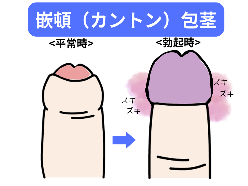 泌尿器科の専門医が徹底解説】包茎でセックスする6つのリスク