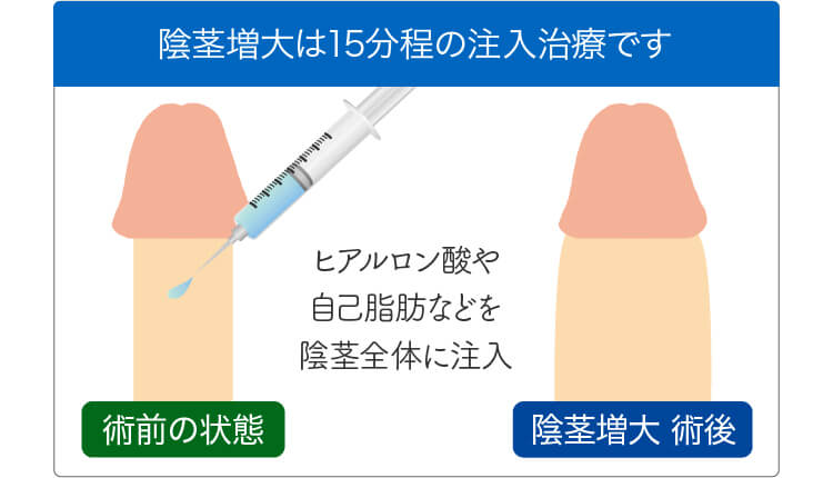 サウナはペニス増大に効果がある！勃起力は血行の良さが大事 | ザヘルプM