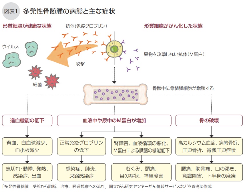 CKDに潜む多発性骨髄腫 岩崎 滋樹 先生