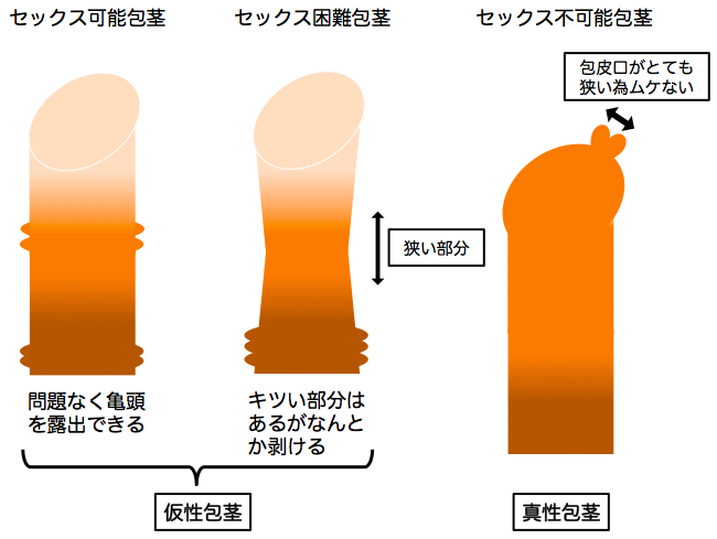 有楽町美容外科クリニック：包茎治療＋亀頭増大術セット