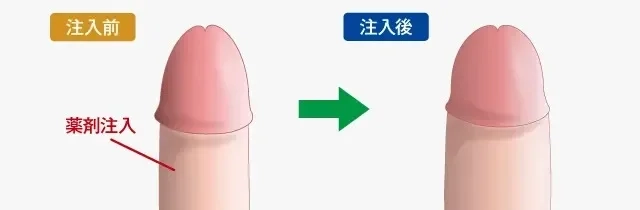 綺麗なちんこと言われるサイズや形とは？女性にとっての綺麗なちんこは？ | 【フェアクリニック】包茎・薄毛・男の悩み相談所