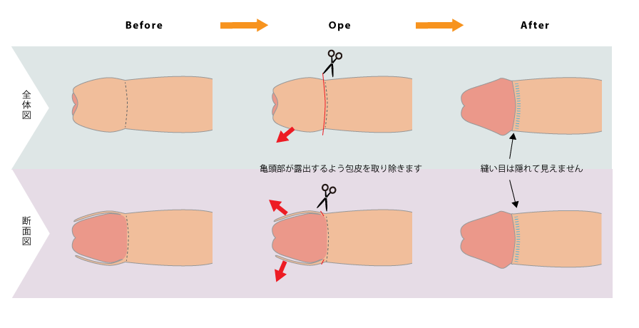 カントン包茎（嵌頓包茎）とは？手術と費用について｜MSクリニック