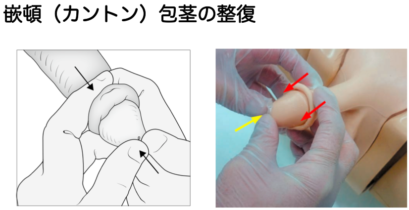 包茎だとコンドームを付けづらい？正しい付け方や選び方について解説！ ｜包茎手術・治療なら上野クリニック