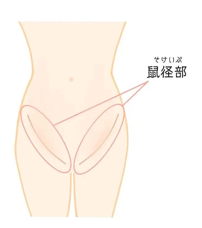 鼠径部のふくらみや痛みの原因は鼠径ヘルニア？早期発見の重要性 - 東京の鼠径ヘルニア日帰り手術専門│調布駅前そけいヘルニアクリニック【公式】