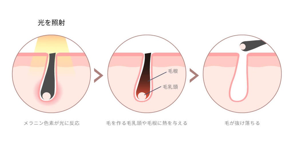 ヒゲの丸してるところが毛根ですか？ - もしそうなら抜けばも -