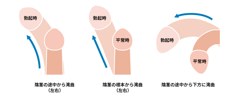 あの『ペニスの形』には意味があるの？ちんこの亀頭があの形の理由【ラブコスメ】