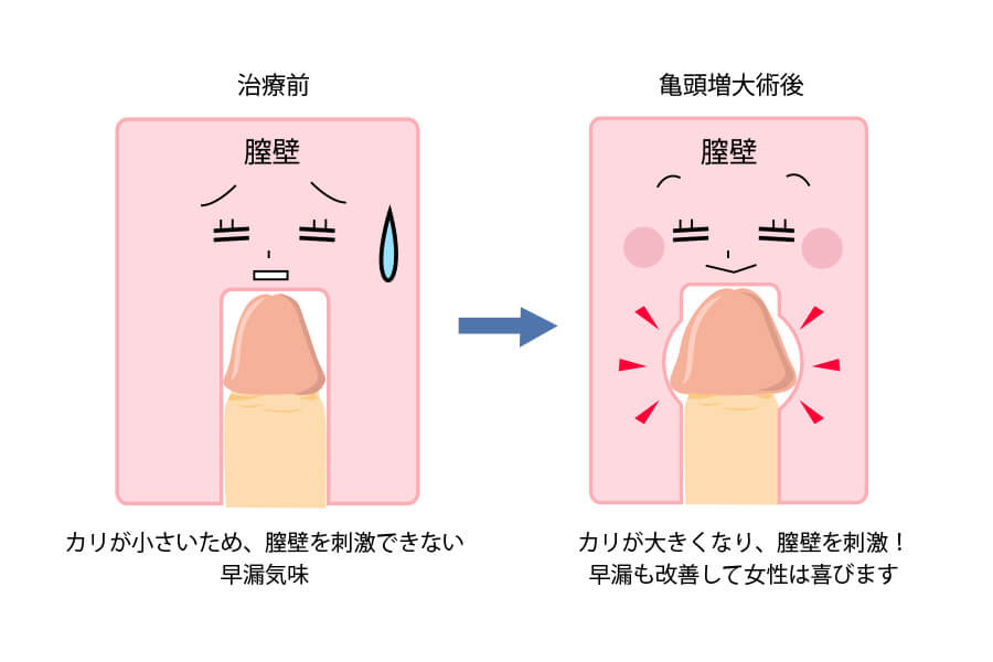 カリ高】ペニス亀頭特化チントレ４選【図解・動画解説】 | セクテクサイト