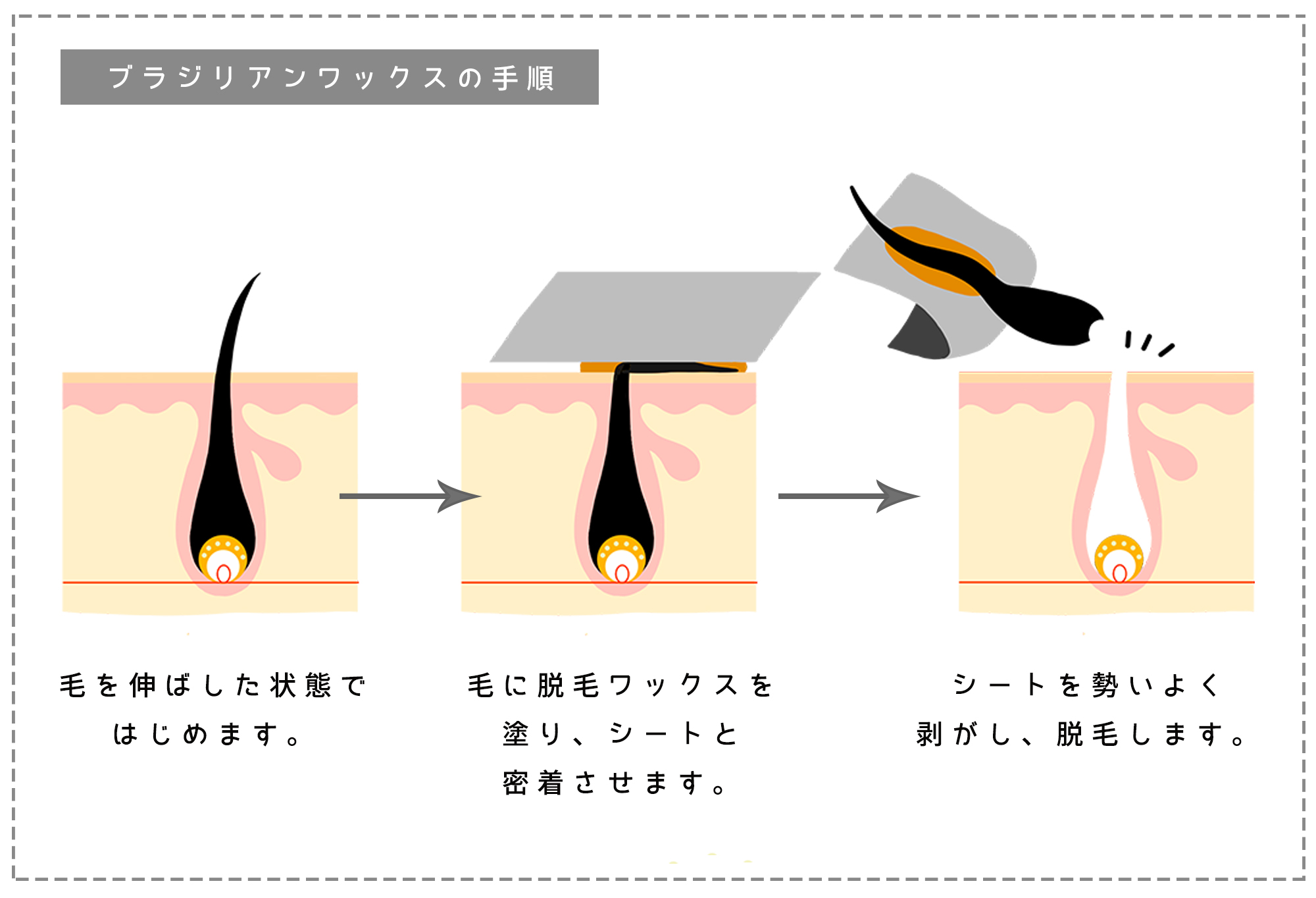 埋没毛】ブラジリアンワックス脱毛の代表的なトラブルを解消する方法 | アンジェリカ