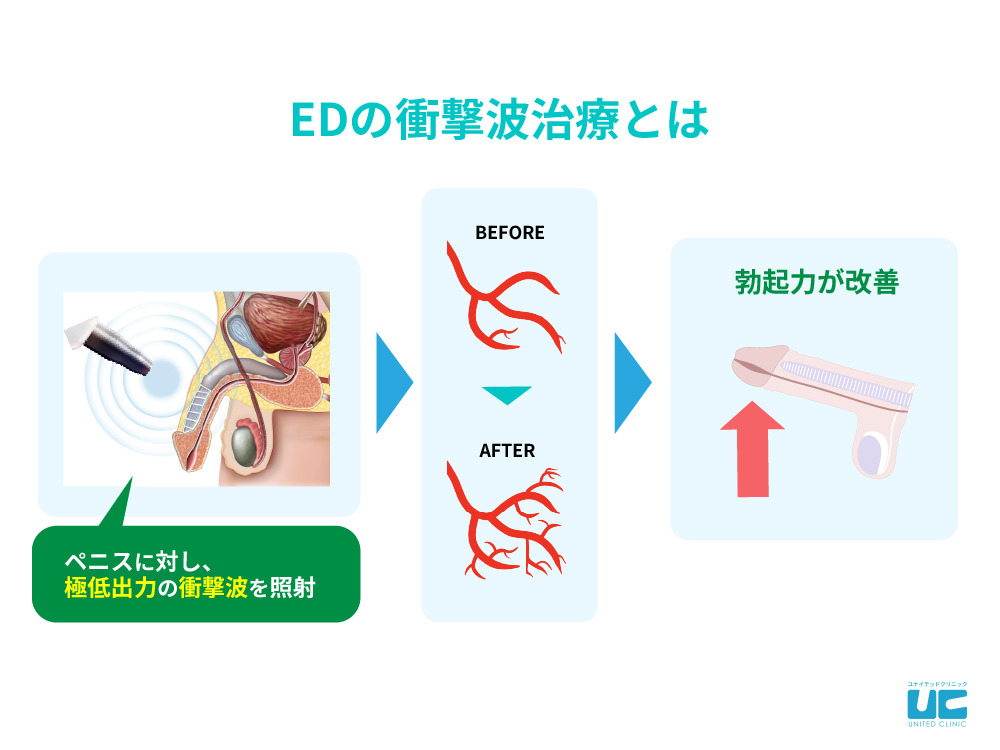 コックリング（ペニスリング）の使い方は？注意点や素材ごとの特徴も解説 |【公式】ユナイテッドクリニック