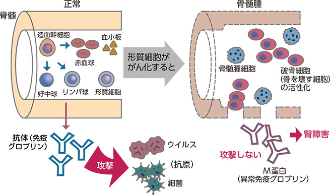 多発性骨髄腫 ブログ記事 ランキング