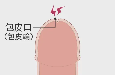 包茎でもセックスできる？手術が必要な包茎の種類とは - アモーレクリニック