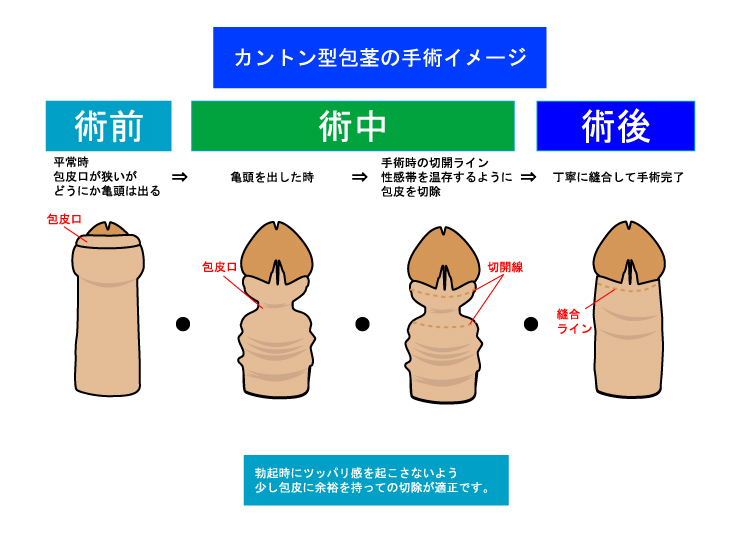 日帰り包茎手術ならおかだ泌尿器科クリニックへ｜京都市西京区『桂駅』直結